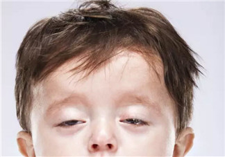 婴儿鬼脸综合症症状图有哪些 过量补钙造成鬼脸综合症的危害是什么